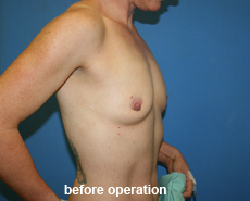 plastic-surgery-breast-augmentation